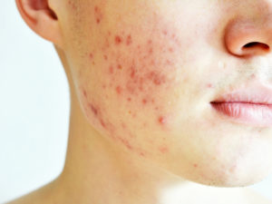 Tratamiento Acné activo y Cicatrices de acné